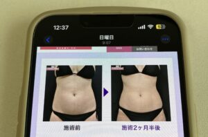 サクセンダ 効果 症例