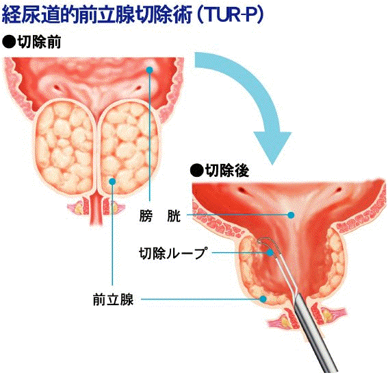 TURP(経尿道的前立腺切除術)